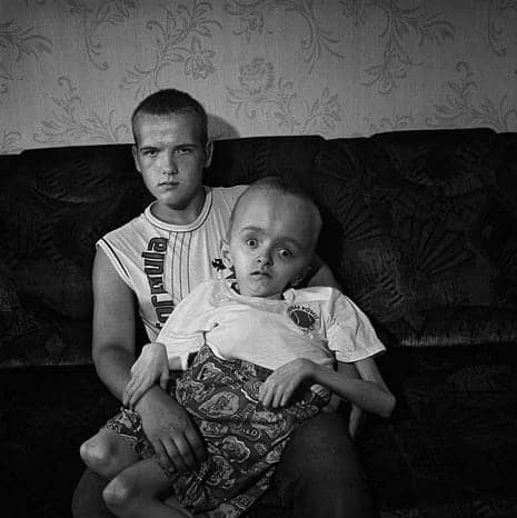 Chernobyl-twin-brothers-Michael-hydrocephalus-Vladimir-deaf-Iariga-16-Minsk-Belarus-by-Robert-Knoth, Chernobyl: Consequences of the catastrophe 25 years later, World News & Views 