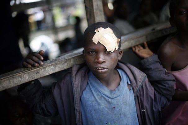 Bandaged-boy-Mugunga-3-refugee-camp-outside-Goma-120212-by-Jerome-Delay-AP, Withhold U.S. aid to speed end of atrocities in Congo, World News & Views 
