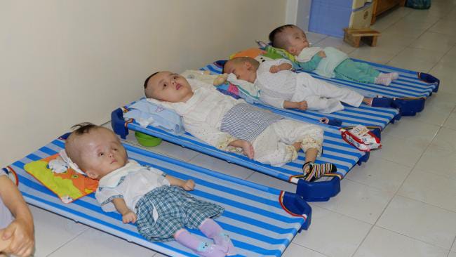 Vietnamese-children-hydrocephalus-Huu-Loc-3-Ti-Ni-12-Tinh-4-Tu-5-by-Ash-Anand-Newsmodo, The Blue Angels air show: San Francisco’s choice, Local News & Views 