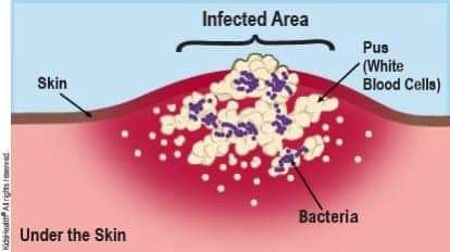 Abcess-formation-by-Nemours-KidsHealth, The landfill in our bodies, Local News & Views 