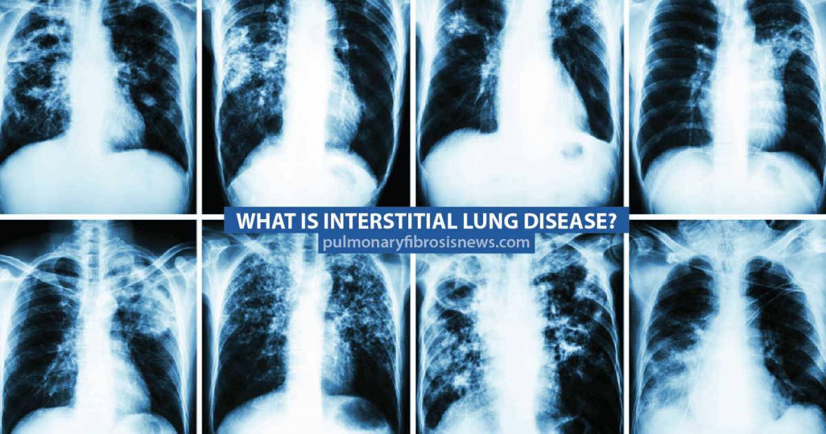 Interstitial-lung-disease-chest-xrays, Perfect storm: First wave of the COVID-19 pandemic crashes in Southeast San Francisco, Local News & Views 