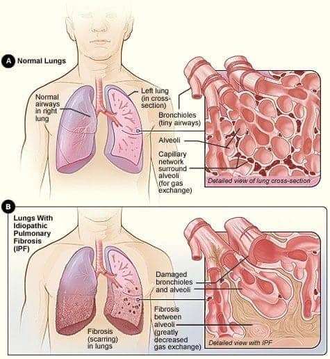 Normal-lungs-compared-to-lungs-with-idiopathic-pulmonary-fibrosis-graphic, From mother to martyr: Remembering Marie Harrison on the anniversary of her ‘very last breath’, Culture Currents 