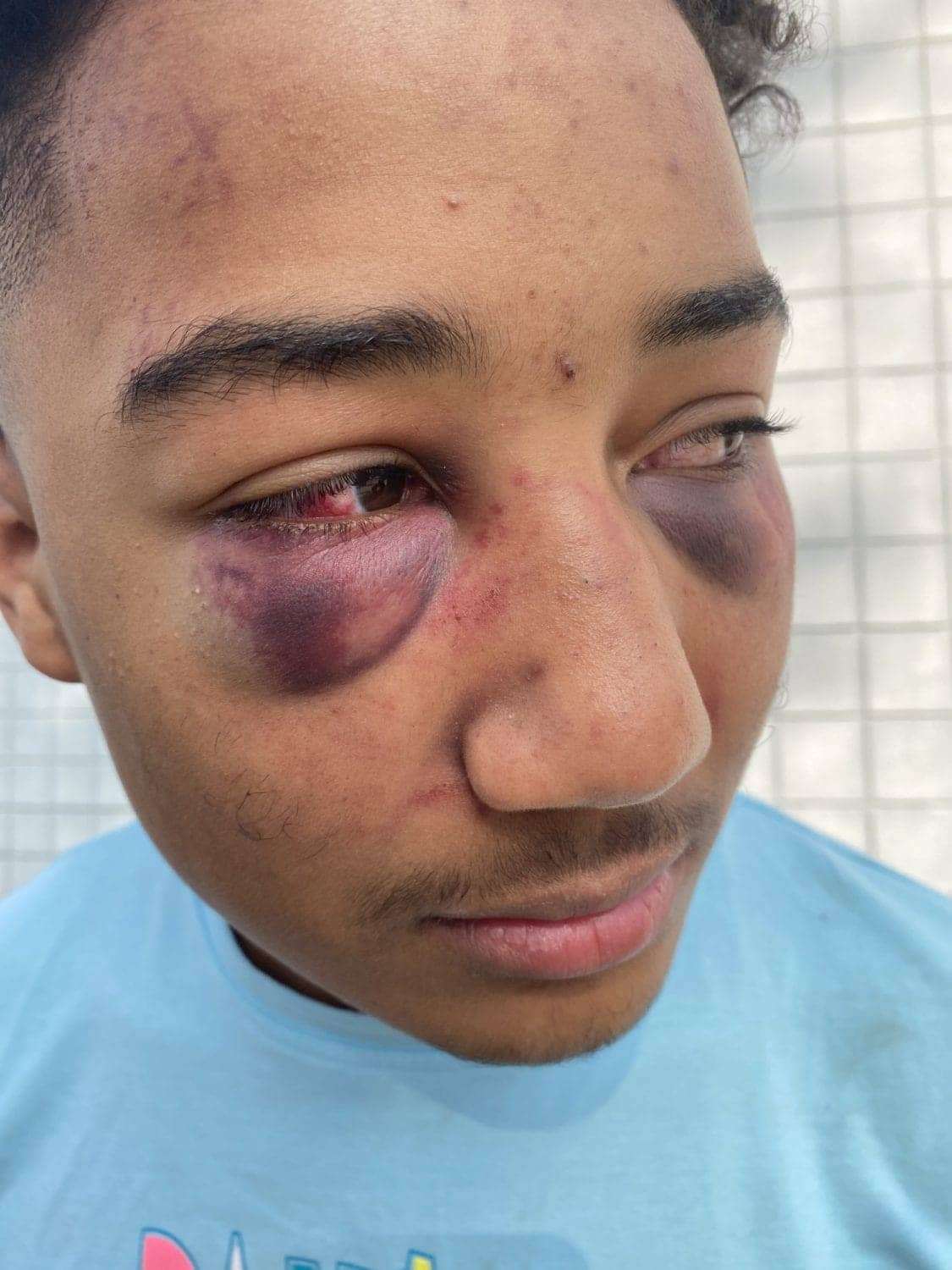 Devin-Carter-17-after-Stockton-cops-beating-123020, John Burris on the indictment of two Stockton cops for viciously beating Devin Carter, 17, Local News & Views 